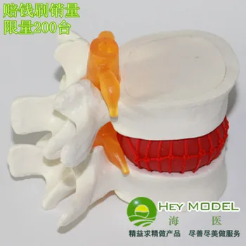 модель поясничного отдела позвоночника, модель грыжи поясничного диска человека, модель скелета человека